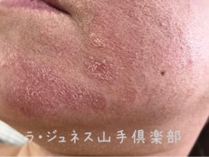 リアクションのお肌
