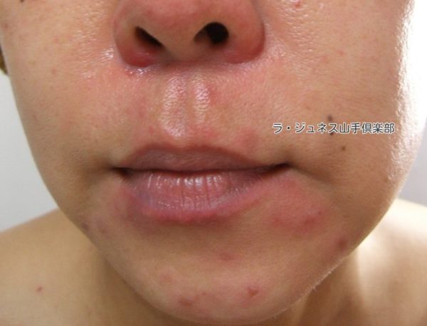 肌が薄いビニール肌 山下小百合の美容論 ラ ジュネス山手倶楽部 肌が薄いビニール肌 山下小百合の美容論 ラ ジュネス山手倶楽部