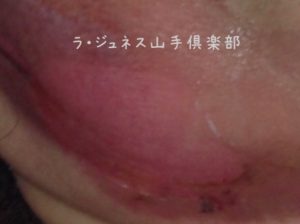 日焼け後の処置