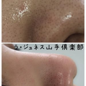 小鼻の角栓 山下小百合の美容論 ラ ジュネス山手倶楽部